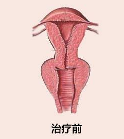 阴道紧缩术案例分享 合肥现代妇科做私密整形无忧患