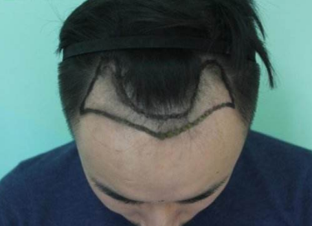 头发种植后可以吸烟吗