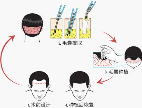 发际线高怎么办 苏州维多利亚植发专家来支招