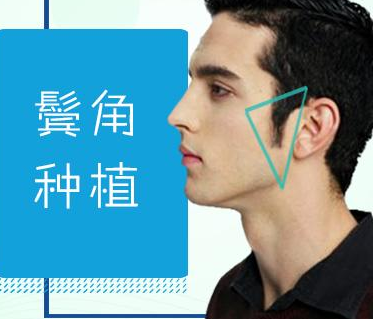 鬓角种植优势有哪些