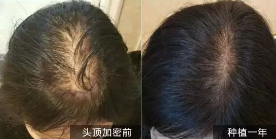 西安头发加密多少钱 会不会很贵