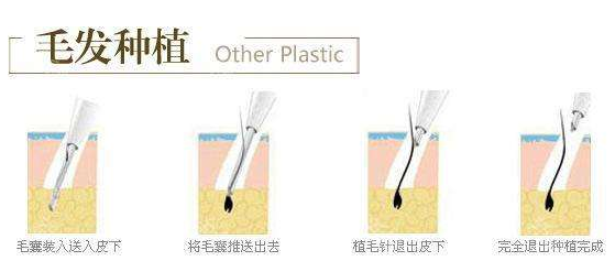 贵阳瑞丽诗头发种植注意事项
