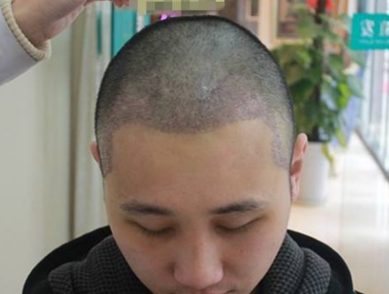 发际线种植后两个月效果图