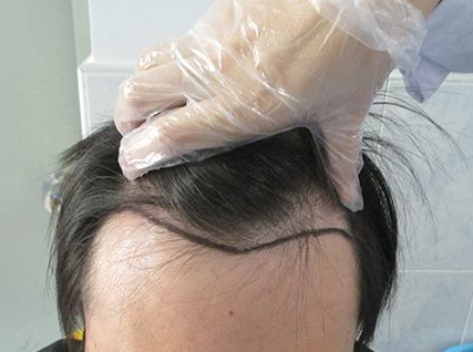 合肥壹加壹发际线种植靠谱吗