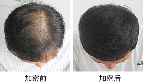 头发加密适宜人群有哪些