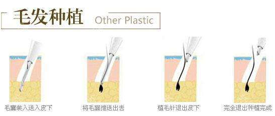 北京武警三院头发种植 解决女性脱发问题的最好方法