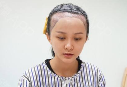 广州瑞丽诗发际线种植效果 大概需要多少钱