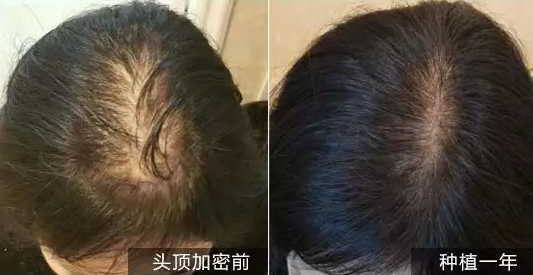 重庆莱森头发加密效果如何