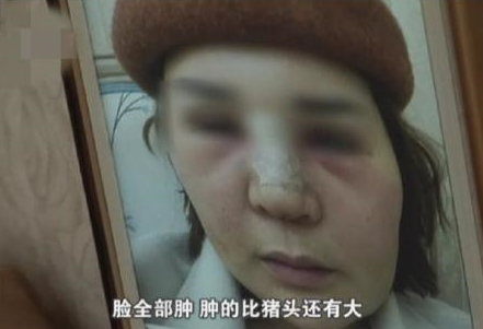 女子花3万元整容，隆鼻变“猪鼻”，整容院：我不是医生