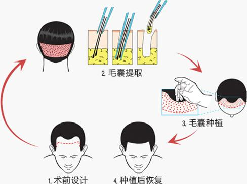 广州雍禾发际线种植是永久的吗
