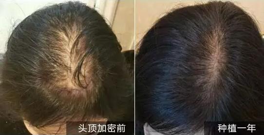 头发加密需要剃光头吗 不剃可以吗