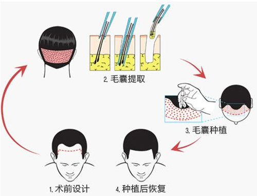 发际线种植疼痛感强烈吗