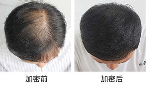 云南昆明头发加密价格是多少
