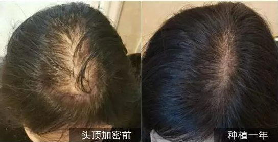 什么是头发加密 头发加密有副作用吗