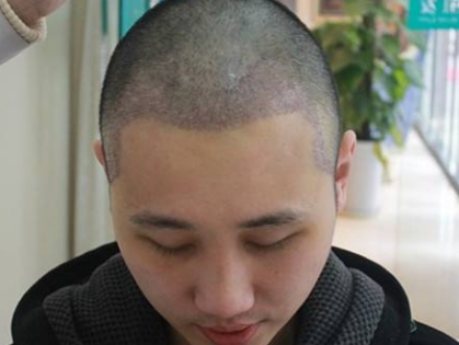 广州头发种植一般多少钱