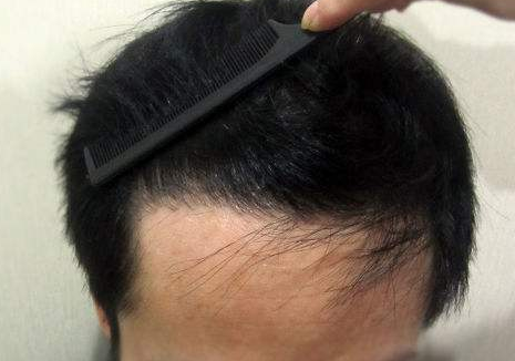 青岛科发源发际线种植 先看看你适不适合