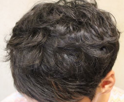 重庆真伊头发种植效果如何 有危害吗