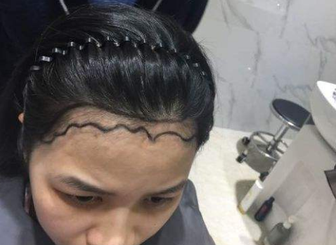 想要做发际线调整 先来看你适不适合