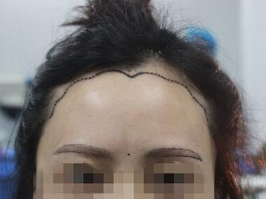 美人尖种植后毛囊存活率高吗 还会不会脱落