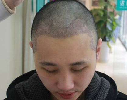 脱发洗发水真的管用吗