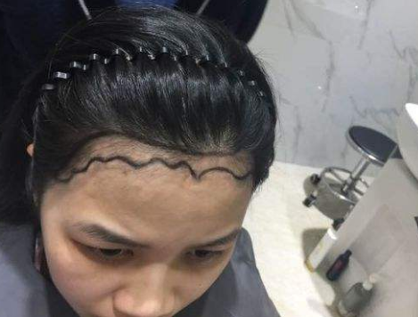 发际线变高怎么办