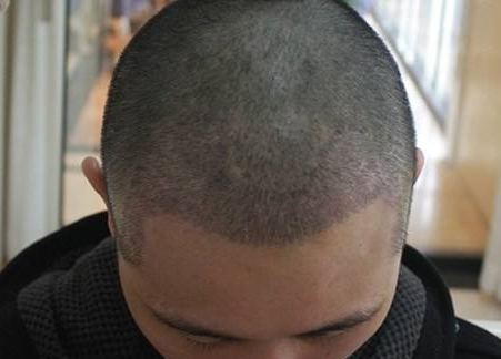 植发后脱落期是什么时候 植发能维持多久