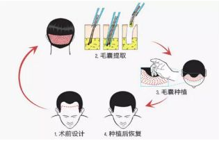 种发和植发价位