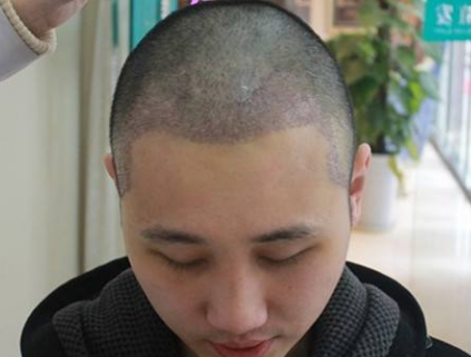 生发剂有用吗 你还在用生发剂?这才是一劳永逸的生发方法