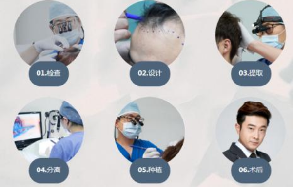 什么是无痛头发种植 适宜人群有哪些