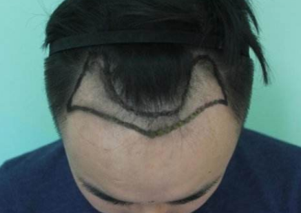 种头发的步骤是怎样的 效果如何