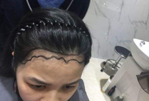 发际线后移的原因