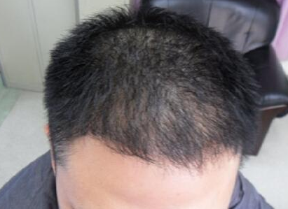 雄性型脱发需要注意些什么