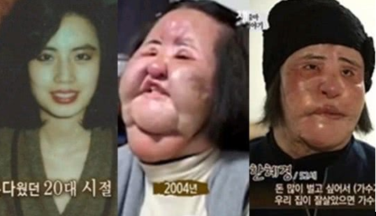 韩整容女星57岁过世，生前色拉油注入全脸9年无法闭眼