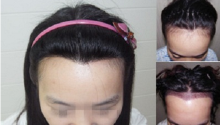 东莞美立方整形医院美人尖种植 原来你是这样美