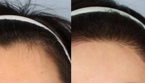 发际线怎么调整 福州雍禾发际线调整好吗