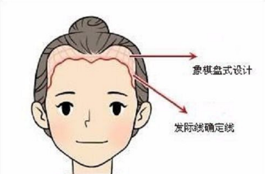 发际线上移怎么办 大连雍禾来帮忙