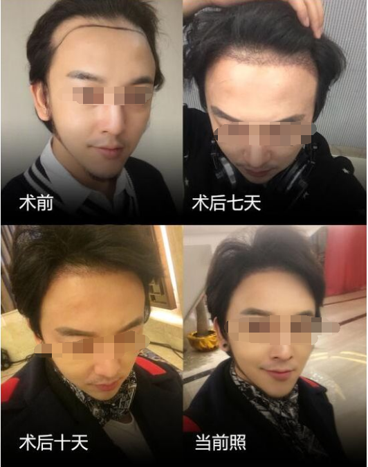 合肥壹加壹发际线种植的优势有哪些  贵吗