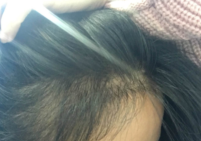合肥华美发际线种植 不让你未老先秃