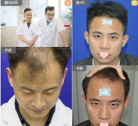 杭州碧莲盛种植发际线怎么样  需要多少钱