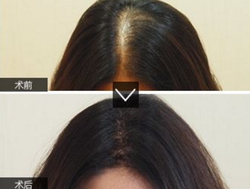 种植头发手术是怎样的?广州新生怎么样