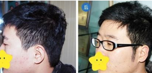 鬓角稀疏短小怎么办  鬓角种植多久能看到效果