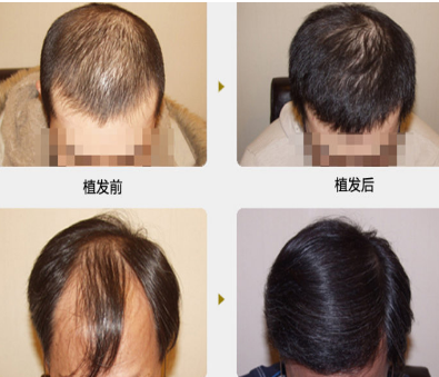 广州曙光头发种植  让你的头发看见曙光