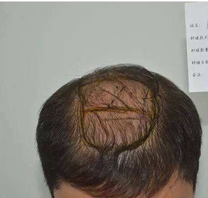 哪些人群适合头发种植  徐州有美怎么样