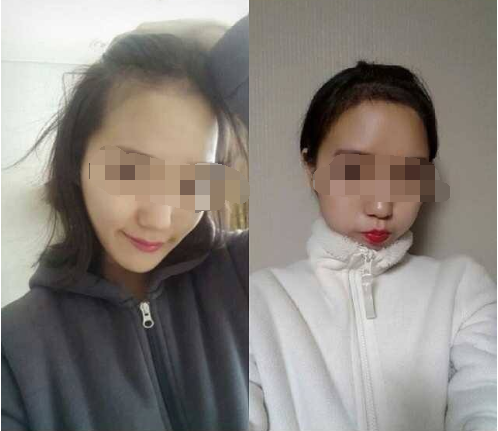 植发后还会不会再次脱发  北京添禾植发怎么样