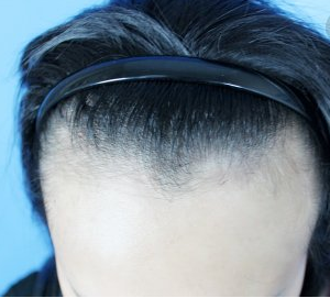 发际线过高怎么办 发际线种植有没有危害
