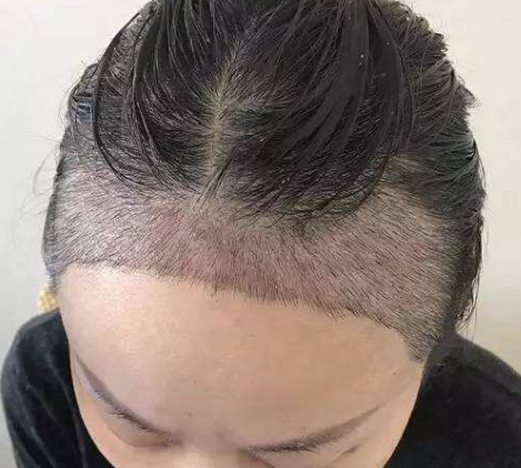 南宁科发源发际线种植适合哪些人