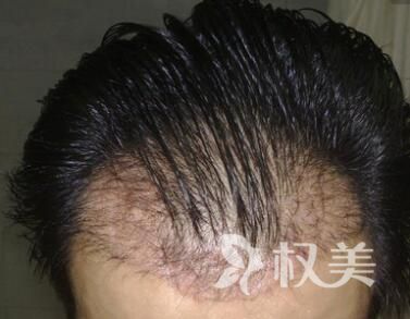 重庆仁爱医院植发整形科头发种植需要多少钱 效果怎么样