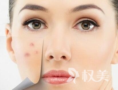 襄樊枣阳市第一人民医院整形外科光子去痘印 让肌肤更光滑