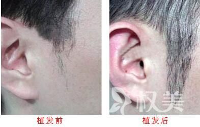 上海哪家医院植发好_申江鬓角种植效果好不好