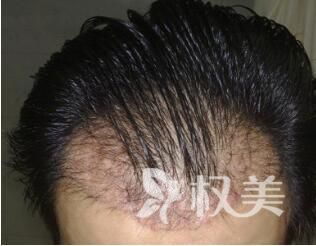 北京植发价格表_北京添禾植发整形医院头发加密种植效果